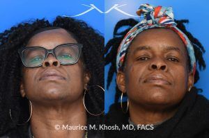 Photo of a patient before and after a procedure. Successful Osteoma Removal After Prior Attempt - This lovely patient sought consultation after a previous attempt to excise a large osteoma had been unsuccessful. We successfully removed the osteoma using a power drill, ensuring optimal results.