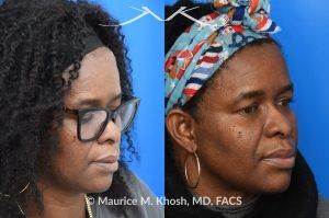 Photo of a patient before and after a procedure. Successful Osteoma Removal After Prior Attempt - This lovely patient sought consultation after a previous attempt to excise a large osteoma had been unsuccessful. We successfully removed the osteoma using a power drill, ensuring optimal results.