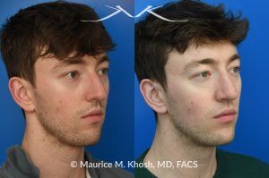 Photo of a patient before and after a procedure. Repair of Left Nasal Valve with Spreader Graft - This patient suffered a nasal fracture that resulted in the collapse of the left nasal valve. Reconstruction included a spreader graft on the right side and removal of the nasal hump. The surgery improved his breathing, enhanced nasal symmetry, and eliminated the bump on his nasal bridge.