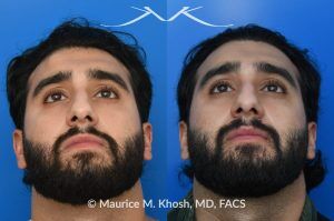 Photo of a patient before and after a procedure. Large Osteoma Removal Under Local Anesthesia - This large osteoma was successfully removed under local anesthesia using a power drill. The patient is ecstatic about his results. 
