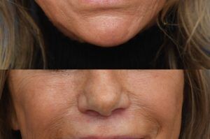 Photo of a patient before and after a procedure. Upper Lip Revision and Filler Correction - This procedure involved repairing the upper lip after filler injections and performing a revision upper lip lift to address horizontal wrinkles beneath the nose. The results show significant improvement in both appearance and skin smoothness.