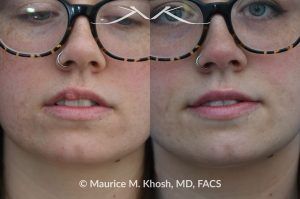 Photo of a patient before and after a procedure. Right Upper Lip Scar Removal - Prior trauma had resulted in a visible mass in the right upper lip. Scar revision of the lip allowed restoration of normal lip contour.