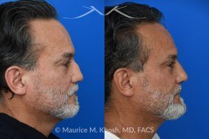 Photo of a patient before and after a procedure. Rib Cartilage Rhinoplasty with Dorsal Hump Reduction and Tip Refinement - Rhinoplasty Using Autologous Rib Cartilage to Correct High Dorsal Septal Deviation Following Unsuccessful Septoplasty, with Simultaneous Dorsal Hump Reduction and Nasal Tip Rotation.