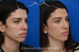 Photo of a patient before and after a procedure. Revision rhinoplasty for nasal dorsum and tip correction - This revision rhinoplasty addressed over-resection of the nasal dorsum and over-rotation of the tip using ear cartilage and Alloderm.