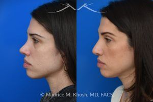Photo of a patient before and after a procedure. Revision rhinoplasty for nasal dorsum and tip correction - This revision rhinoplasty addressed over-resection of the nasal dorsum and over-rotation of the tip using ear cartilage and Alloderm.