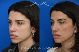 Photo of a patient before and after a procedure. Revision rhinoplasty for nasal dorsum and tip correction - This revision rhinoplasty addressed the over-resection of the nasal dorsum and over-rotation of the nasal tip, using ear cartilage and Alloderm for reconstruction. The left image shows the pre-operative appearance, while the middle image shows the nose before the revision procedure.