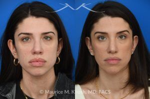 Photo of a patient before and after a procedure. Revision rhinoplasty for nasal dorsum and tip correction - This revision rhinoplasty addressed over-resection of the nasal dorsum and over-rotation of the tip using ear cartilage and Alloderm.