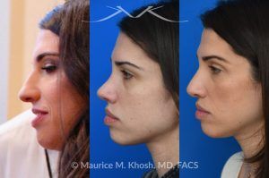 Photo of a patient before and after a procedure. Revision rhinoplasty for nasal dorsum and tip correction - This revision rhinoplasty addressed over-resection of the nasal dorsum and over-rotation of the tip using ear cartilage and Alloderm.