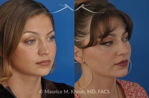 Photo of a patient before and after a procedure. Saddle Nose Reconstruction Using Rib Cartilage - 27 year old with saddle nose collapse due to an autoimmune condition. She was bothered by the unnatural sag of the bridge of the nose, loss of nasal tip definition, and nasal obstruction. Her own rib cartilage was used during saddle nose rhinoplasty, to reconstruct the nose and restore breathing. The last two images show the computer simulation of surgical outcome (middle picture), as well as the final outcome (the picture on the right side). Patient is delighted with her results. 