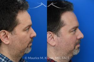 Photo of a patient before and after a procedure. Endoscopic Forehead Lipoma Removal - This patient presented with a subtle, 1-inch diameter bump in the center of the forehead caused by a lipoma—a benign fatty tumor. The mass was removed endoscopically through a concealed hairline incision, leaving no visible scarring and restoring a smooth forehead contour.