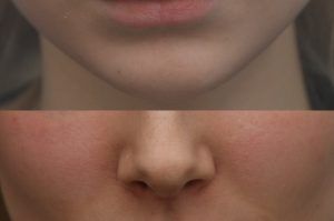 Photo of a patient before and after a procedure. Lip Augmentation with HA Filler - Before and after photo showing improved fullness and symmetry of the lips.
