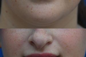 Photo of a patient before and after a procedure. Lip Augmentation with HA Filler - Before and after photo showing improved fullness and symmetry of the lips.