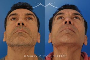 Photo of a patient before and after a procedure. Repair nasal valve obstruction revision rhinoplasty - This gentleman had previously undergone two rhinoplasty operations over 15 years ago. His nasal tip was pinched and obstructing his breathing, Cadaver rib cartilage was used to strengthen and support his external nasal valve. The nasal tip was slightly elevated.