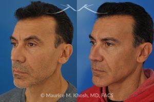 Photo of a patient before and after a procedure. Repair nasal valve obstruction revision rhinoplasty - This gentleman had previously undergone two rhinoplasty operations over 15 years ago. His nasal tip was pinched and obstructing his breathing, Cadaver rib cartilage was used to strengthen and support his external nasal valve. The nasal tip was slightly elevated.
