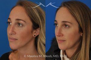 Photo of a patient before and after a procedure. Rhinoplasty to address a bulbous droopy and asymmetric nasal tip - before-and-after composite photo.