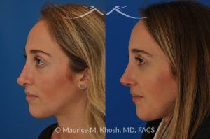 Photo of a patient before and after a procedure. Rhinoplasty to address a bulbous droopy and asymmetric nasal tip - before-and-after composite photo.