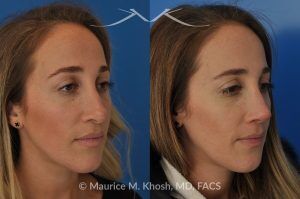Photo of a patient before and after a procedure. Rhinoplasty to address a bulbous droopy and asymmetric nasal tip - before-and-after composite photo.