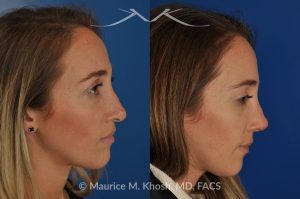 Photo of a patient before and after a procedure. Rhinoplasty to address a bulbous droopy and asymmetric nasal tip - before-and-after composite photo.