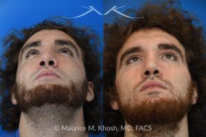 Photo of a patient before and after a procedure. Revision rhinoplasty with ear cartilage graft and osteotomies - This 26 year-old had previously undergone rhinoplasty which resulted in over-resection of the nasal bridge and excess width of the bony nasal dorsum. He underwent revision rhinoplasty in Manhattan by us. Ear cartilage was used to augment the height of the nasal bridge. The nasal bones were broken and moved closer to each other, to narrow the bridge. He is ecstatic with his revision rhinoplasty results. 