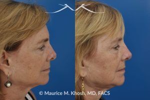 Photo of a patient before and after a procedure. Revison rhinoplasty to straighten a twisted tip - This lovely patient had rhinoplasty many years ago. She had skin cancer removed from the tip of her nose over five years ago. This resulted in a twisted and asymmetric nasal tip. The nasal tip was repaired during an open revision rhinoplasty, utilizing rib cartilage grafts.