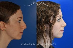 Photo of a patient before and after a procedure. Nasal Hump Reduction and Tip Elevation - This 27 year old requested rhinoplasty in New York to address a large nasal hump and to improve the nasal tip in a subtle and natural manner. The images show her before and after photos 6 months after surgery. The last two images show our computer simulation of the appearance of the bridge of her nose, in the middle images. Note the similarity of the simulation photos to the final outcome. 