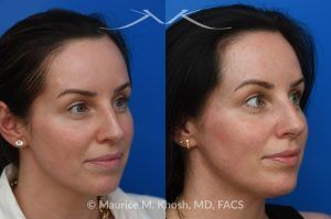Photo of a patient before and after a procedure. Forehead Osteoma Removal With Hidden Hairline Incision - A visible bump above the patient’s right eyebrow was caused by a forehead osteoma. It was removed through a concealed incision in the hairline, leaving no visible scar and a smooth result.
