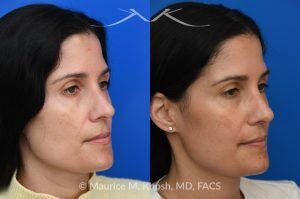 Photo of a patient before and after a procedure. Right Upper Forehead Osteoma Removal with Concealed Hairline Incision - This patient was bothered by a gradually enlarging osteoma in the right upper forehead. The growth was successfully removed through a well-concealed hairline incision, restoring a smooth and natural forehead contour with no visible scarring.