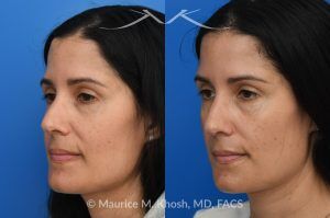 Photo of a patient before and after a procedure. Right Upper Forehead Osteoma Removal with Concealed Hairline Incision - This patient was bothered by a gradually enlarging osteoma in the right upper forehead. The growth was successfully removed through a well-concealed hairline incision, restoring a smooth and natural forehead contour with no visible scarring.