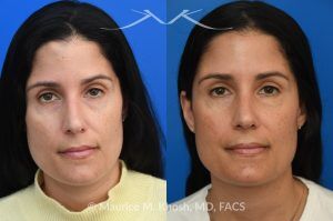 Photo of a patient before and after a procedure. Right Upper Forehead Osteoma Removal with Concealed Hairline Incision - This patient was bothered by a gradually enlarging osteoma in the right upper forehead. The growth was successfully removed through a well-concealed hairline incision, restoring a smooth and natural forehead contour with no visible scarring.