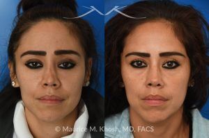 Photo of a patient before and after a procedure. Saddle nose rhinoplasty - This patient had previously undergone an unsuccessful rhinoplasty surgery with cadaver rib cartilage graft. She had developed a saddle collapse of her nose and loss of nasal tip definition. Her own rib and temporalis fascia was used to reconstruct the nose. She is ecstatic with her results at 6 months post op. 