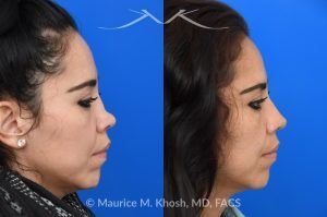 Photo of a patient before and after a procedure. Saddle nose rhinoplasty - This patient had previously undergone an unsuccessful rhinoplasty surgery with cadaver rib cartilage graft. She had developed a saddle collapse of her nose and loss of nasal tip definition. Her own rib and temporalis fascia was used to reconstruct the nose. She is ecstatic with her results at 6 months post op. 