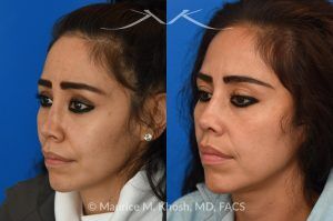 Photo of a patient before and after a procedure. Saddle nose rhinoplasty - This patient had previously undergone an unsuccessful rhinoplasty surgery with cadaver rib cartilage graft. She had developed a saddle collapse of her nose and loss of nasal tip definition. Her own rib and temporalis fascia was used to reconstruct the nose. She is ecstatic with her results at 6 months post op. 