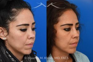 Photo of a patient before and after a procedure. Saddle nose rhinoplasty - This patient had previously undergone an unsuccessful rhinoplasty surgery with cadaver rib cartilage graft. She had developed a saddle collapse of her nose and loss of nasal tip definition. Her own rib and temporalis fascia was used to reconstruct the nose. She is ecstatic with her results at 6 months post op. 
