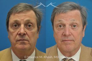 Photo of a patient before and after a procedure. Revision open approach rhinoplasty with septum cartilage graft - Previous rhinoplasty in this gentleman had caused nasal obstruction, pinched and retracted nostrils, and excess columellar show. Revision open approach rhinoplasty with septum cartilage graft allowed restoration of breathing, and creation of a natural and harmonious appearing nose.