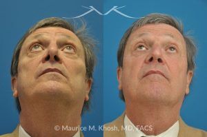 Photo of a patient before and after a procedure. Revision open approach rhinoplasty with septum cartilage graft - Previous rhinoplasty in this gentleman had caused nasal obstruction, pinched and retracted nostrils, and excess columellar show. Revision open approach rhinoplasty with septum cartilage graft allowed restoration of breathing, and creation of a natural and harmonious appearing nose.