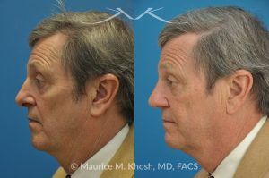 Photo of a patient before and after a procedure. Revision open approach rhinoplasty with septum cartilage graft - Previous rhinoplasty in this gentleman had caused nasal obstruction, pinched and retracted nostrils, and excess columellar show. Revision open approach rhinoplasty with septum cartilage graft allowed restoration of breathing, and creation of a natural and harmonious appearing nose.