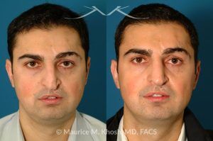 Photo of a patient before and after a procedure. Revision rhinoplasty via an open approach, utilizing cartilage graft - Patient with cleft lip nasal deformity. Previous rhinoplasty had been unsuccessful at restoring the droopy tip and asymmetric nasal tip. Revision rhinoplasty via an open approach, utilizing cartilage grafts successfully elevated the nasal tip and achieved tip symmetry.