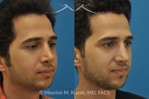 Photo of a patient before and after a procedure. Revision rhinoplasty via the open approach - Previous rhinoplasty in this young man had been a failure. The tip was raised too high, the nose was too short, and the tip was pinched. Revision rhinoplasty via the open approach successfully addressed the abnormalities and rendered the nose more aesthetic and natural in its appearance.