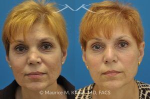 Photo of a patient before and after a procedure. Saddle Nose - before-and-after composite photo.