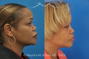 Photo of a patient before and after a procedure. Saddle Nose - before-and-after composite photo.