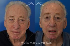 Photo of a patient before and after a procedure. Nasal valve repair and revision rhinoplasty - This 73 year old had previously undergone rhinoplasty in his 20's. The surgery had left his nose deformed and severely obstructed. Revision rhinoplasty and repair of nasal vestibular stenosis was accomplished with use of cadaver rib cartilage. Revision surgery helped to restore a natural shape to the nose, and alleviate his breathing issues. He is delighted with the surgical results.