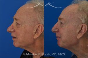 Photo of a patient before and after a procedure. Nasal valve repair and revision rhinoplasty - This 73 year old had previously undergone rhinoplasty in his 20's. The surgery had left his nose deformed and severely obstructed. Revision rhinoplasty and repair of nasal vestibular stenosis was accomplished with use of cadaver rib cartilage. Revision surgery helped to restore a natural shape to the nose, and alleviate his breathing issues. He is delighted with the surgical results.