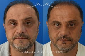 Photo of a patient before and after a procedure. Revision rhinoplasty, nasal valve reconstruction - This 53 year old had originally undergone rhinoplasty over 30 years ago. Surgery had left his nose pinched, depressed, short, and deformed. He had severe nasal obstruction. Revision rhinoplasty was performed with the use of his own rib cartilage to restore a normal shape to his nose and improve his breathing.