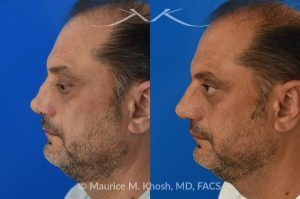 Photo of a patient before and after a procedure. Revision rhinoplasty, nasal valve reconstruction - This 53 year old had originally undergone rhinoplasty over 30 years ago. Surgery had left his nose pinched, depressed, short, and deformed. He had severe nasal obstruction. Revision rhinoplasty was performed with the use of his own rib cartilage to restore a normal shape to his nose and improve his breathing.