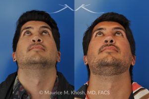 Photo of a patient before and after a procedure. Revision rhinoplasty for cleft lip nose deformity - This 24 year-old with congenital cleft lip nasal deformity had previously undergone surgery on his nose. As a result of that previous surgery the nose tip had become overly up-turned and the middle vault of the nose was pinched appearing. The right nostril base was depressed relative to the normal left side. Revision rhinoplasty in New York was performed with rib cartilage which was harvested from the patient's own chest. The 7 month results (on the left side) show a dramatic improvement in regards to the shape and position of the nasal tip, middle vault of the nose, and the position of the right nostril base. 