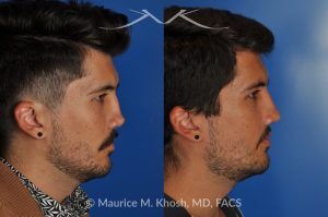 Photo of a patient before and after a procedure. Revision rhinoplasty for cleft lip nose deformity - This 24 year-old with congenital cleft lip nasal deformity had previously undergone surgery on his nose. As a result of that previous surgery the nose tip had become overly up-turned and the middle vault of the nose was pinched appearing. The right nostril base was depressed relative to the normal left side. Revision rhinoplasty in New York was performed with rib cartilage which was harvested from the patient's own chest. The 7 month results (on the left side) show a dramatic improvement in regards to the shape and position of the nasal tip, middle vault of the nose, and the position of the right nostril base. 