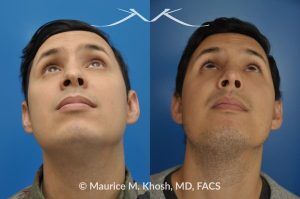 Photo of a patient before and after a procedure. Revision rhinoplasty to improve breathing and refine the tip - This 31 year old had previously undergone a nose job operation at age 17. He had breathing difficulty from both sides of the nose. He also disliked the flat, wide, asymmetric, and under-projected appearance of the tip of the nose. Revision rhinoplasty was performed to restore breathing and improve the appearance of the tip of the nose. Open approach rhinopalsty was used to place bilateral spreader grafts, left alar strut graft, narrow the tip, and improve the projection of the tip of the nose.