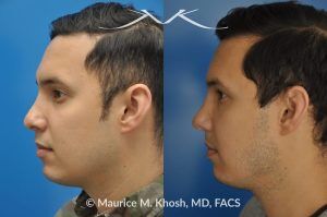 Photo of a patient before and after a procedure. Revision rhinoplasty to improve breathing and refine the tip - This 31 year old had previously undergone a nose job operation at age 17. He had breathing difficulty from both sides of the nose. He also disliked the flat, wide, asymmetric, and under-projected appearance of the tip of the nose. Revision rhinoplasty was performed to restore breathing and improve the appearance of the tip of the nose. Open approach rhinopalsty was used to place bilateral spreader grafts, left alar strut graft, narrow the tip, and improve the projection of the tip of the nose.