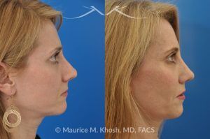 Photo of a patient before and after a procedure. Revision tip rhinoplasty with cartilage graft - This young lady complained of difficulty breathing, significant asymmetry of the nasal tip, and unnatural tip appearance on profile view of the nose following her primary rhinoplasty. The tip symmetry was restored and profile appearance was improved through revision tip rhinoplasty with cartilage grafts.