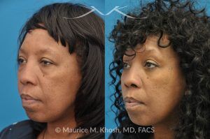 Photo of a patient before and after a procedure. Lower Eyelid Rejuvenation and Temporal Brow Lift - This 55 year old African American lady was interested to addressing lower eyelid puffiness and sagging eyebrow. She underwent lower lid rejuvenation through a trans-conjunctival (inside the eyelid) blepharoplasty and a temporal brow lift.